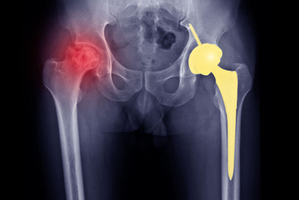 Avascular Necrosis (AVN): The Silent Threat to Your HIP Joint