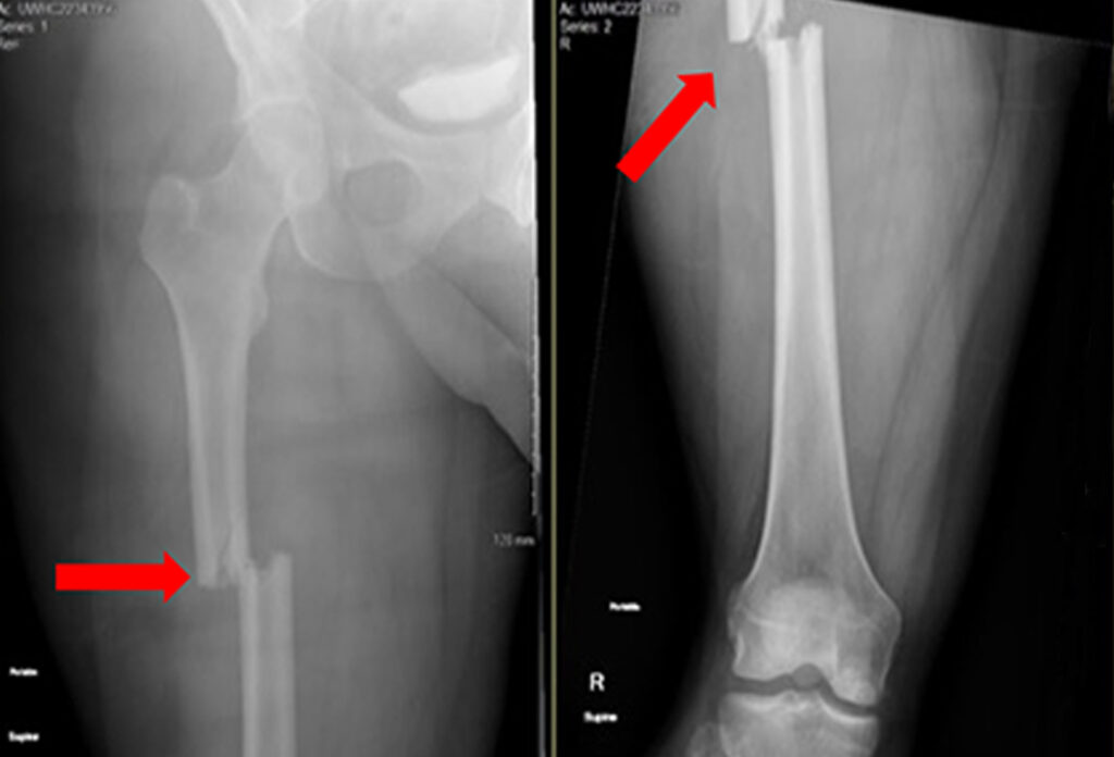 Successful Revision Surgery for Complicated Femur Fracture: A Case Study by Dr. Swapnil Gadge