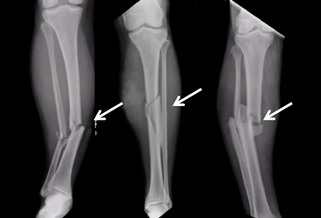 Recovering from a Proximal Tibia Injury: A Comprehensive Case Study