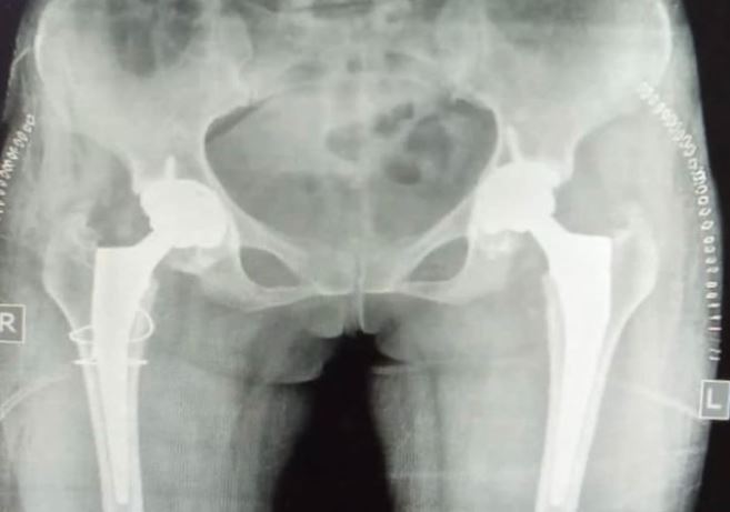 Steroid Induced Avascular Necrosis of Hip joint – Demands Total hip Replacement of Both the hip Joint in Young Female Patient