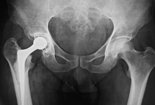 Two Stage Total Hip Replacement for Tubercular Hip Arthritis at Gadge Hospital