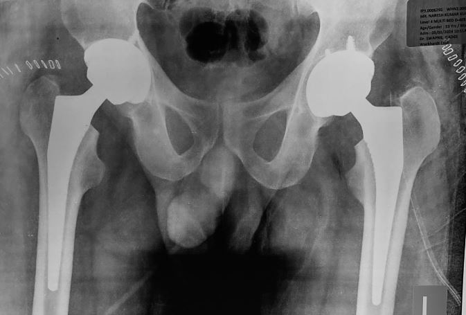 Total hip Replacement for Alcohol induced Avascular necrosis of Hip Joint in young male.