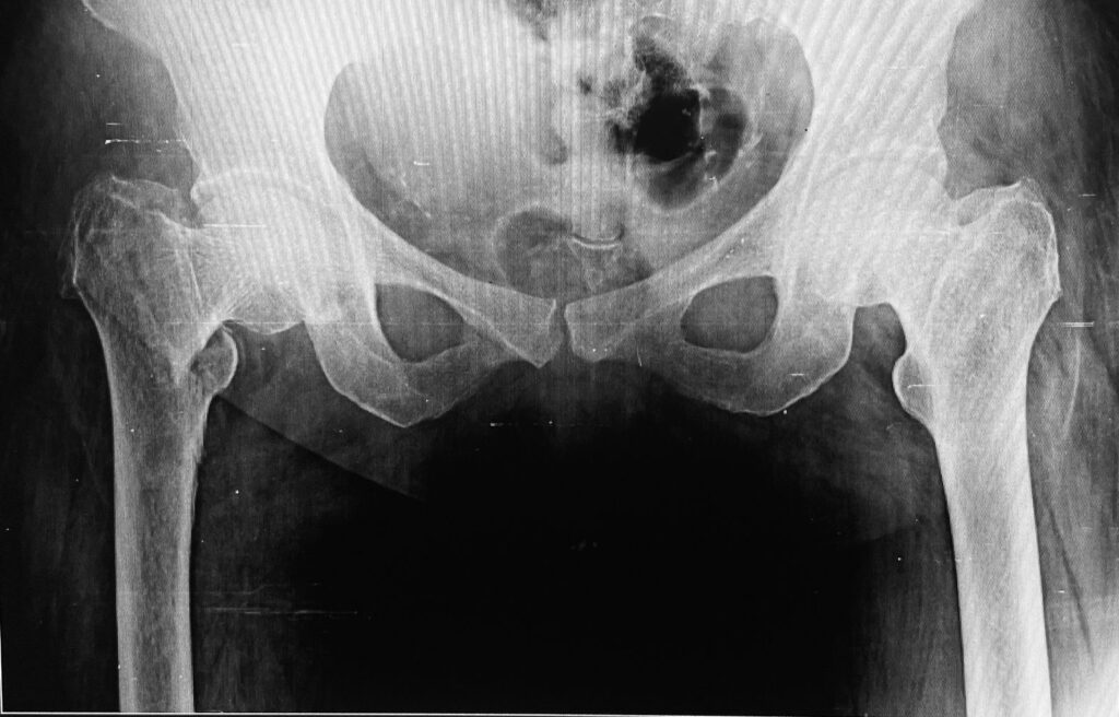 Successful Management of Hip Fracture in an Elderly Female at Gadge Hospital by Dr. Swapnil Gadge
