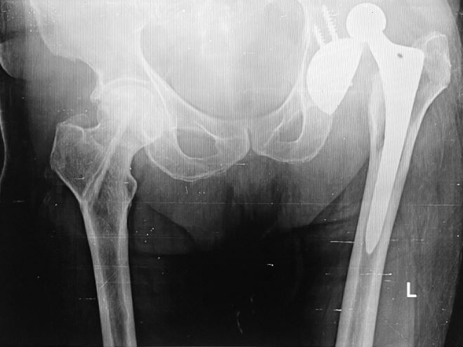 Case Study: Post-Traumatic Dislocation in a 65-Year-Old Male with History of Total Hip Replacement