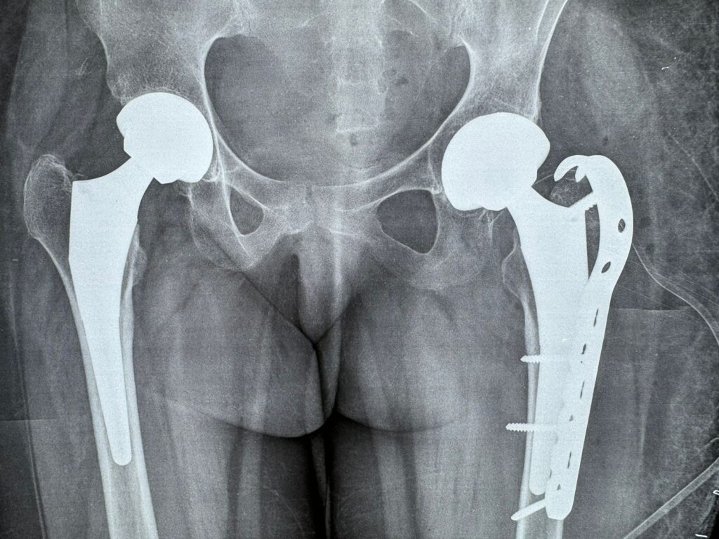 Management of Fracture Following Bilateral Total Hip Replacement: A Case Study