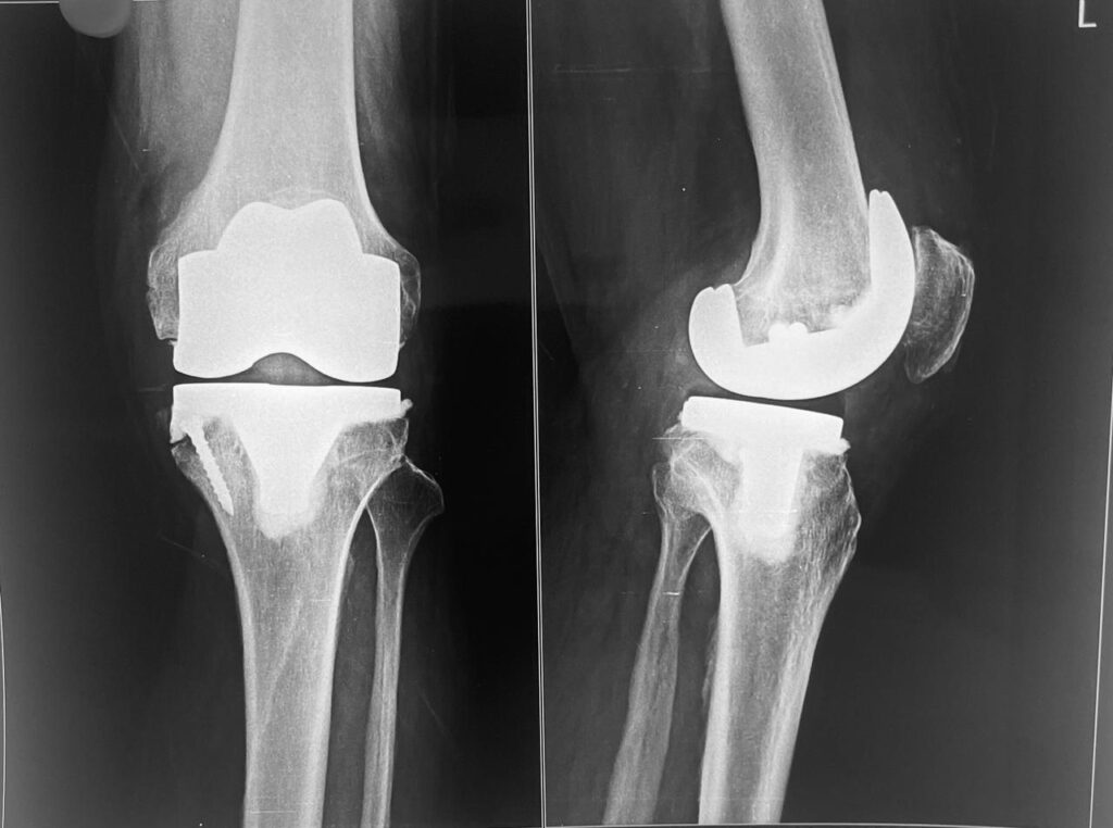 Transforming Lives: Total Knee Replacement Surgery for Chronic Pain Relief
