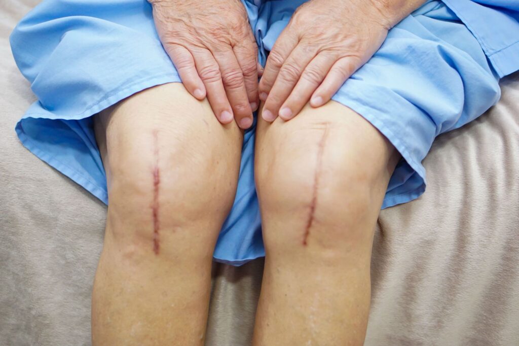 Unveiling The Advantages and Disadvantages of Knee Replacement Surgery
