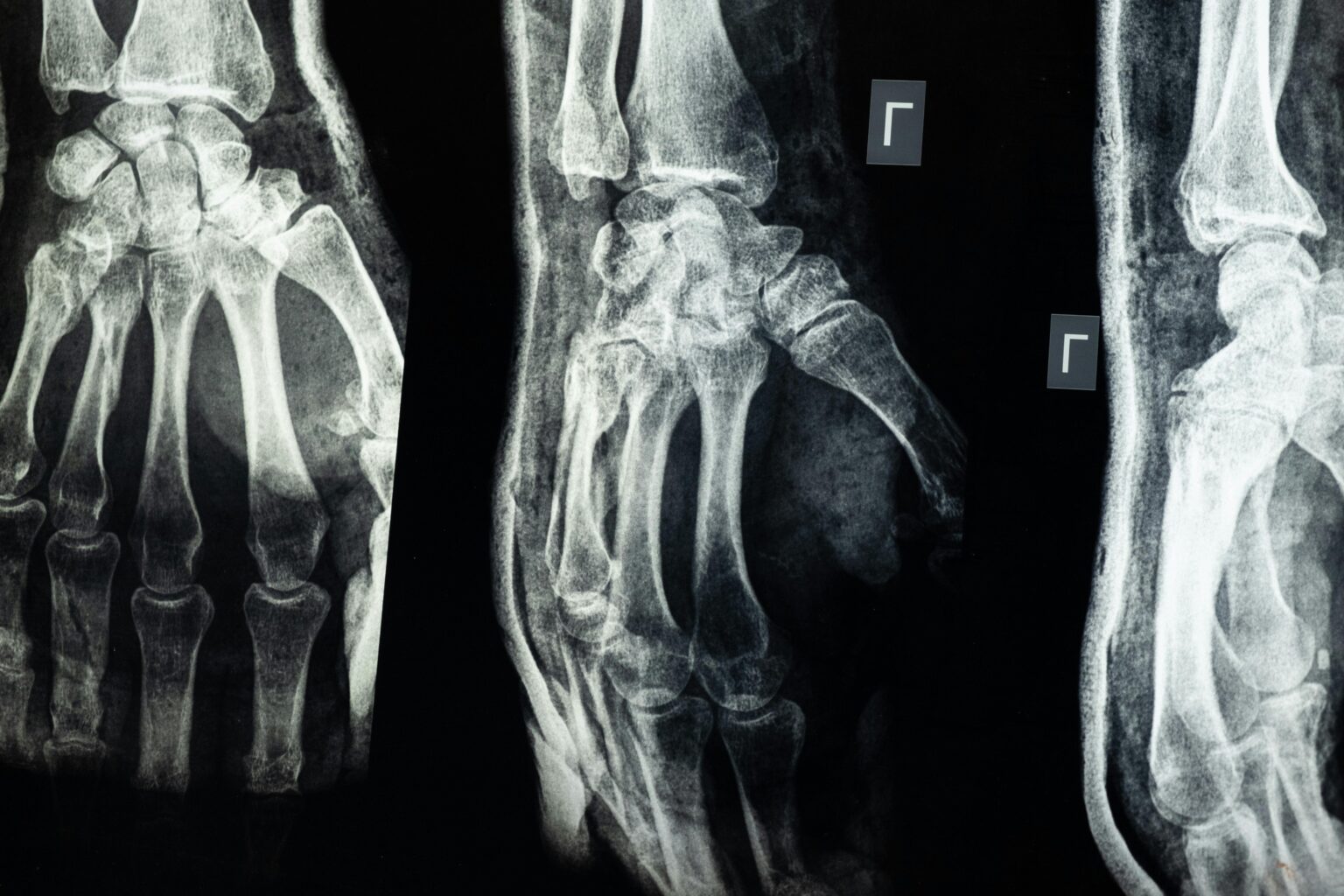 Best Orthopedic Doctor For Fracture Treatment in Nagpur