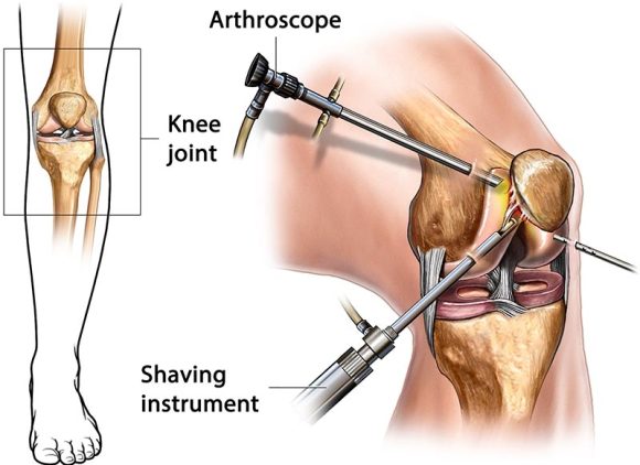 AARCPA Arthroscopic Knee Surgery